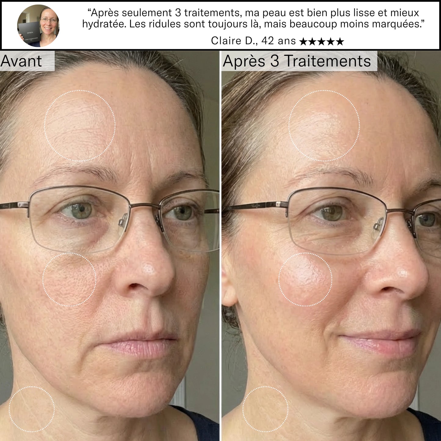 Système de Micro-Infusion