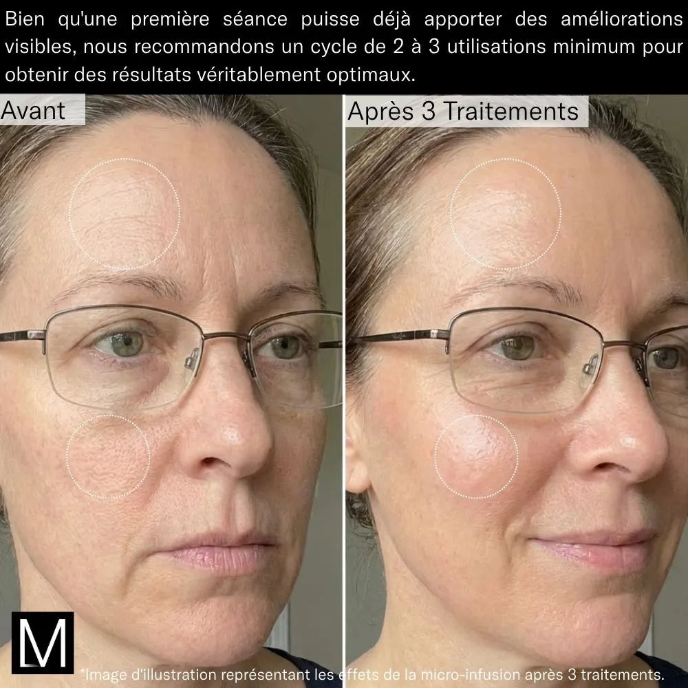 Système de Micro-Infusion