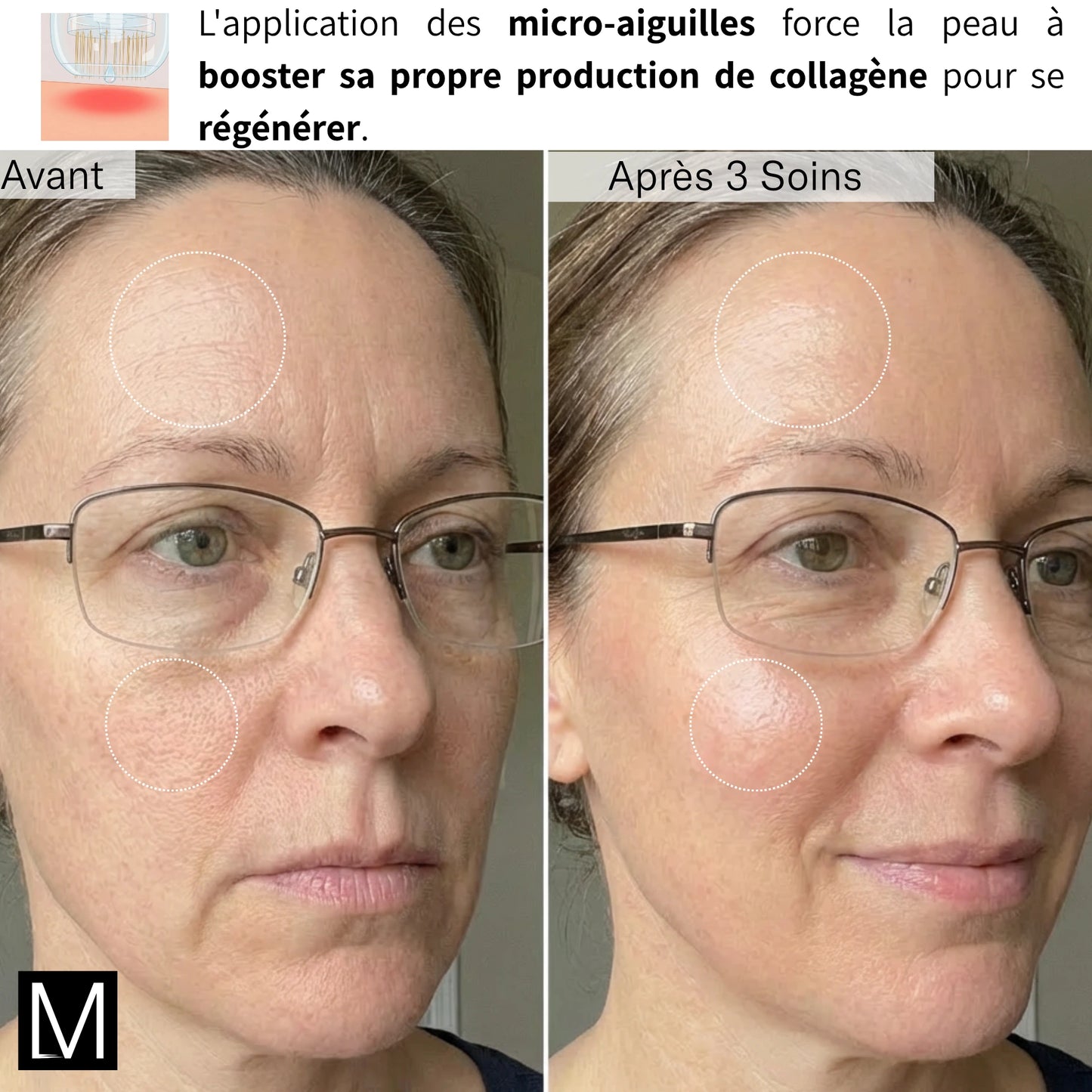 Système de Micro-Infusion