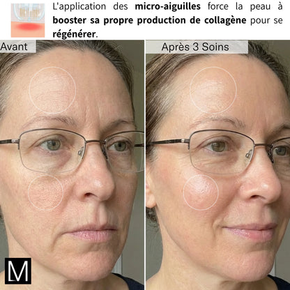 Système de Micro-Infusion